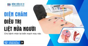 điện châm điều trọ liệt nửa người
