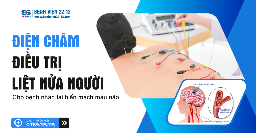 điện châm điều trọ liệt nửa người