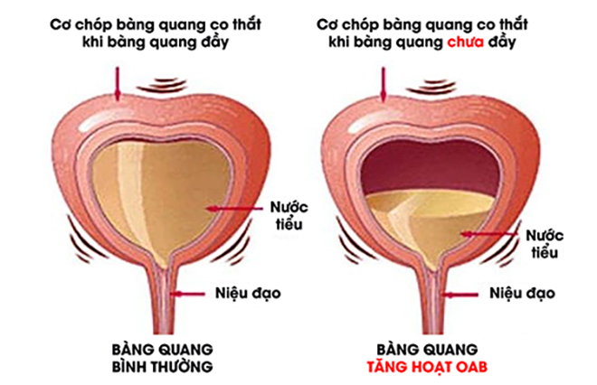 Bệnh viện 22-12 | Tiểu đêm - tiểu nhiều!!! Có thể bạn bị "Bàng quang tăng hoạt" chăng???