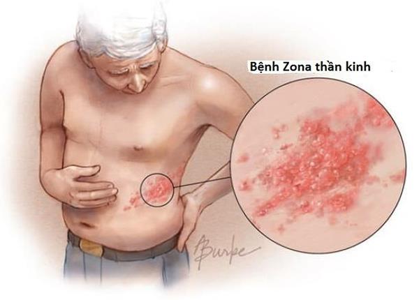 Bệnh viện 22-12 | Bệnh Zona thần kinh (Giời leo) là gì? Biểu hiện và cách điều trị
