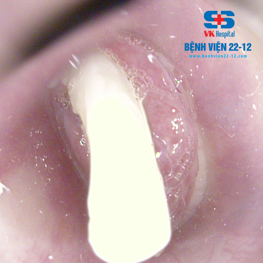 Bệnh viện 22-12 | Nội soi gây mê gắp dị vật trong thực quản