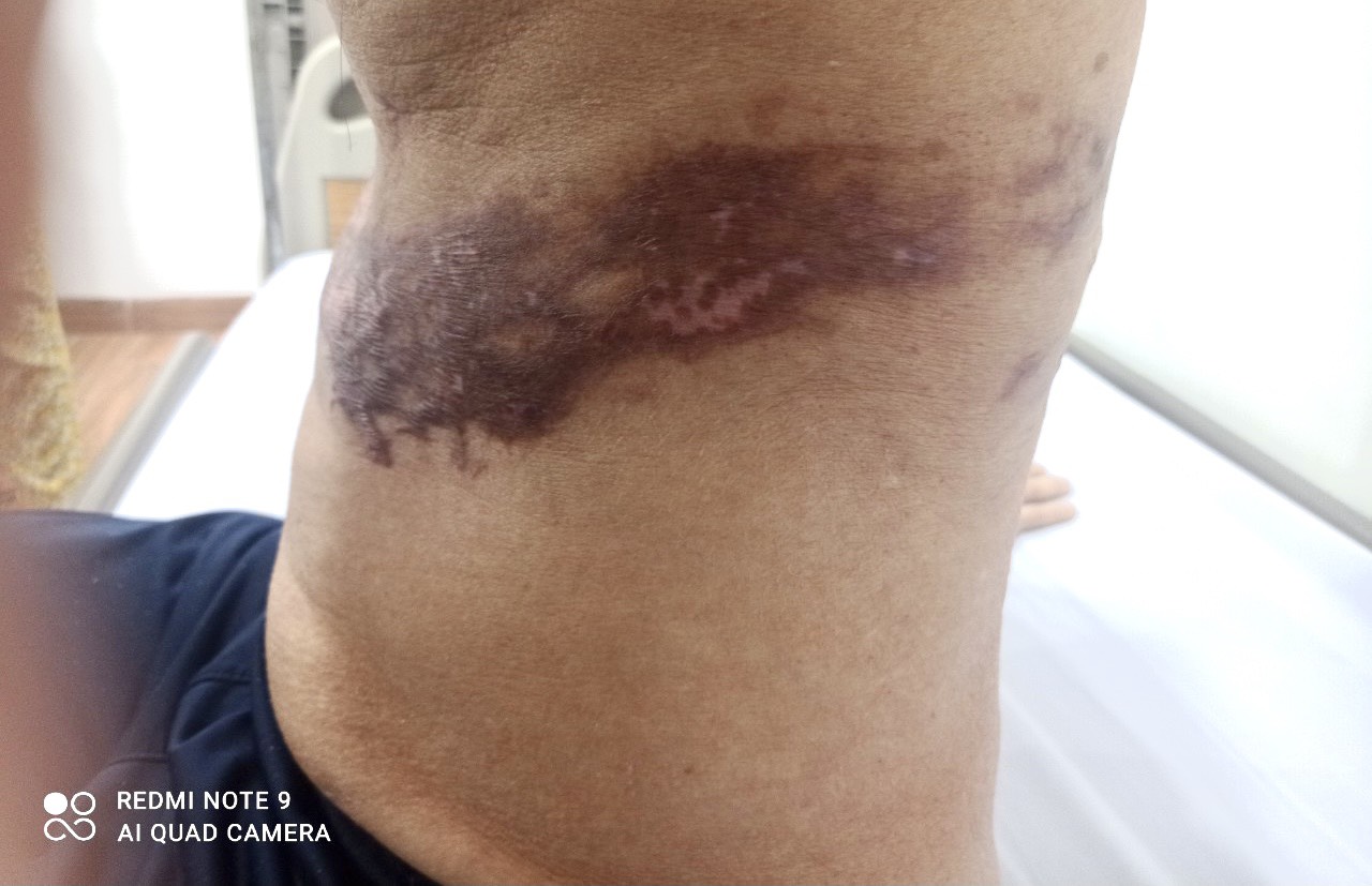 Bệnh viện 22-12 | Bệnh Zona thần kinh (Giời leo) là gì? Biểu hiện và cách điều trị