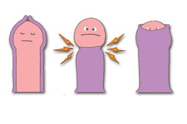 Bệnh viện 22-12 | Bao quy đầu - Những điều cần biết