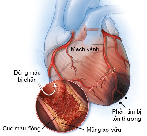 Bệnh viện 22-12 | Thiếu máu cơ tim - Nguyên nhân, dấu hiệu và cách điều trị