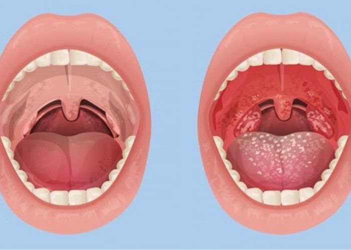 Bệnh viện 22-12 | Viêm họng hạt - Bệnh dai dẳng cần điều trị