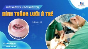 dính thắng lưỡi