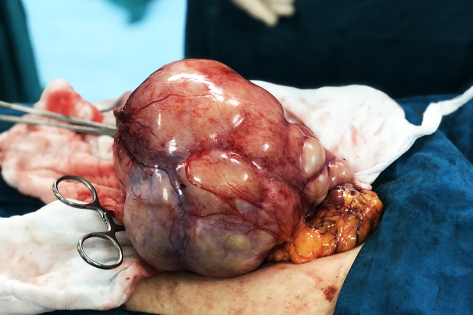 Bệnh viện 22-12: Phẫu thuật thành công nhiều ca khó, hiếm gặp Bệnh viện 22-12: Phẫu thuật thành công nhiều ca khó, hiếm gặp