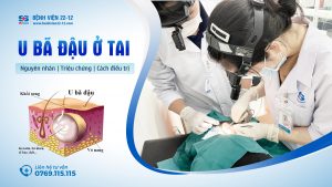 u bã đậu ở tai