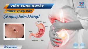 hang vị dạ dày