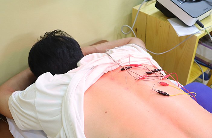 Bệnh viện 22-12 | Điều trị đau thần kinh sau zona Bệnh viện 22-12 điều trị hiệu quả đau thần kinh sau zona bằng châm cứu, điện châm, sóng ngắn ...