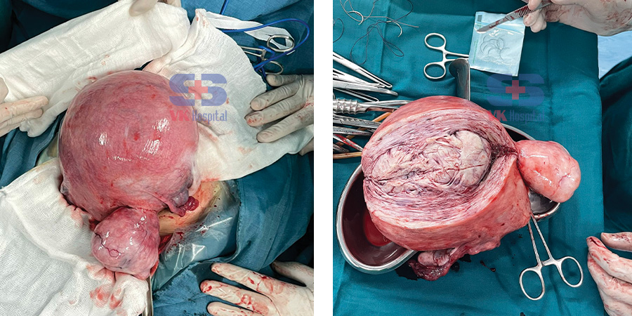 Bệnh viện 22-12 | Phẫu thuật u xơ tử cung Bệnh viện 22-12 | Phẫu thuật u xơ tử cung