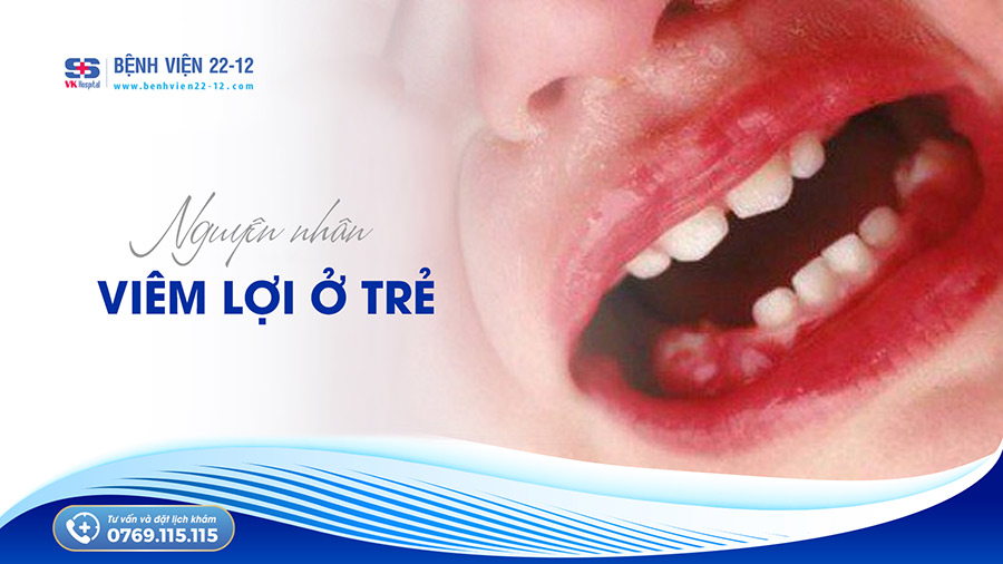 Bệnh viện 22-12 | viêm lợi ở trẻ Bệnh viện 22-12 | viêm lợi ở trẻ