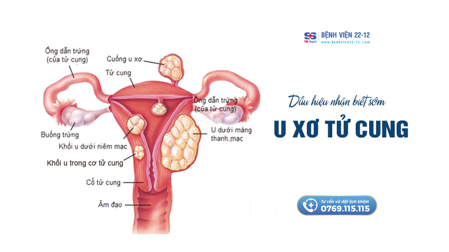 Bệnh viện 22-12 | U xơ tử cung Bệnh viện 22-12 | U xơ tử cung