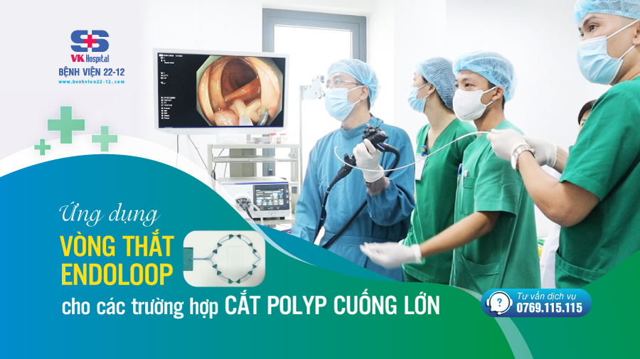 vòng thắt endoloop trong cắt polyp cuống lớn | Bệnh viện 22-12