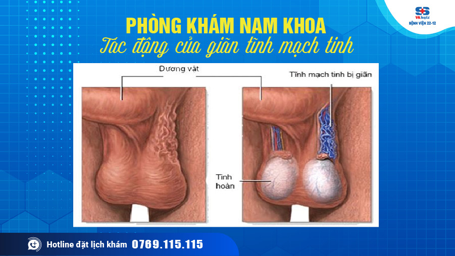 Bệnh viện 22-12 | Tác động của giãn tĩnh mạch tinh Bệnh viện 22-12 | Tác động của giãn tĩnh mạch tinh