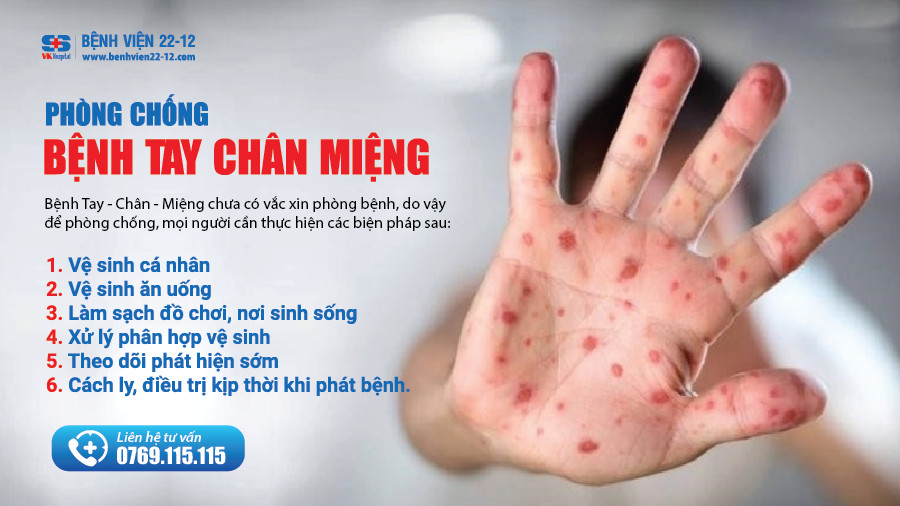 Bệnh viện 22-12 | Phòng chống bệnh tay chân miệng