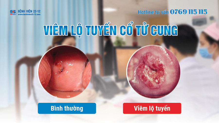 benh vien 22-12/viem lo tuyen co tu cung benh vien 22-12/viem lo tuyen co tu cung
