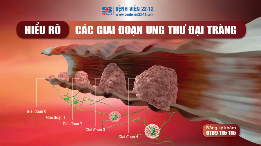 Các giai đoạn ung thư đại tràng Các giai đoạn ung thư đại tràng