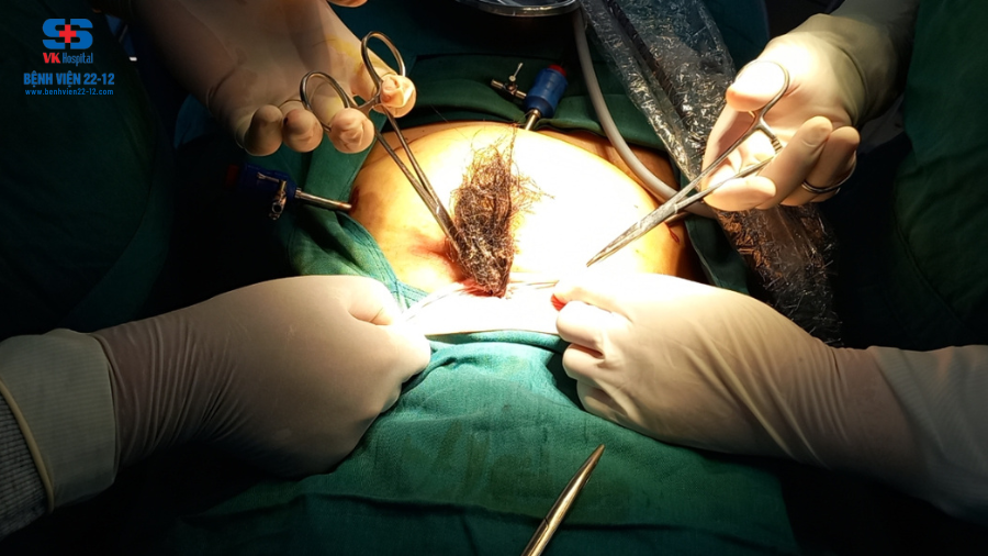 Bệnh viện 22-12/Phẫu thuật nội soi u bì buồng trứng hai bên, vết mổ cũ hai lần Bệnh viện 22-12/Phẫu thuật nội soi u bì buồng trứng hai bên, vết mổ cũ hai lần