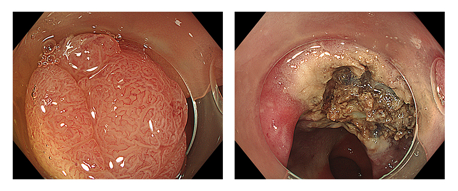 Bệnh viện 22-12/cắt polyp đại tràng bằng phương pháp ESD Bệnh viện 22-12/cắt polyp đại tràng bằng phương pháp ESD