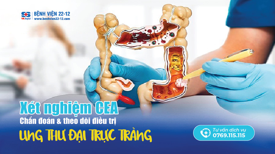 Bệnh viện 22-12 | Xét nghiệm CEA
