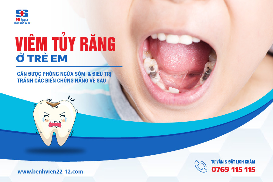 Bệnh viện 22-12 / Phòng ngừa viêm tủy răng ở trẻ em Bệnh viện 22-12 / Phòng ngừa viêm tủy răng ở trẻ em