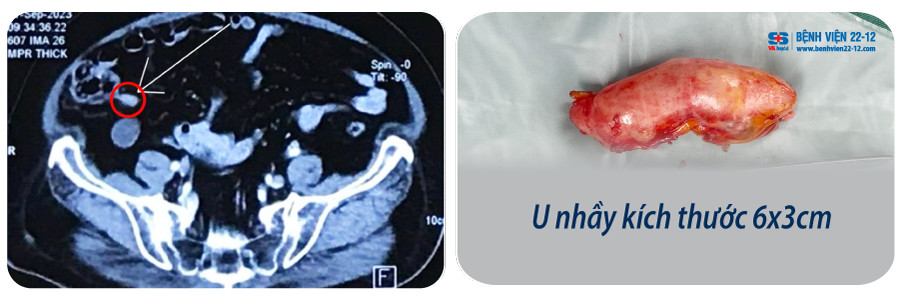 Bệnh viện 22-12 | Phẫu thuật thành công u nhầy ruột thừa bằng phương pháp phẫu thuật nội soi Bệnh viện 22-12 | Phẫu thuật thành công u nhầy ruột thừa bằng phương pháp phẫu thuật nội soi