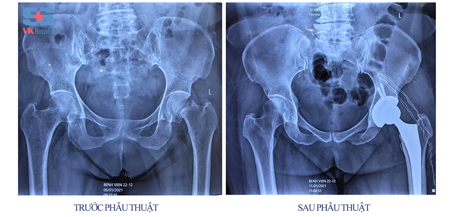 Benh vien 22-12/ phau thuat gay co xuong dui