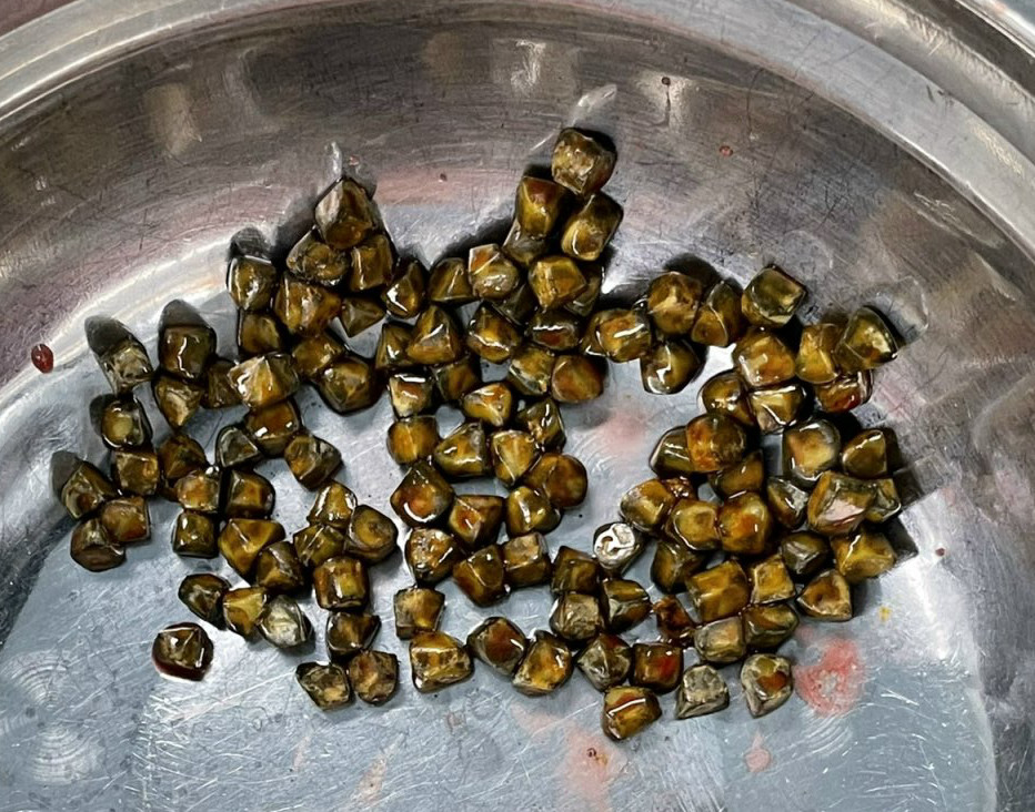 Benh vien 22-12 | Phau thuat noi soi lay ra 113 vien soi tui mat cho nu benh nhan 31 tuoi