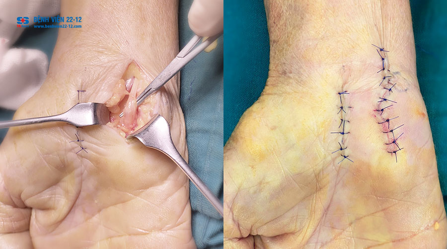 Bệnh viện 22-12 | pt-hoi-chung-OCT-Guyon Bệnh viện 22-12 | pt-hoi-chung-OCT-Guyon