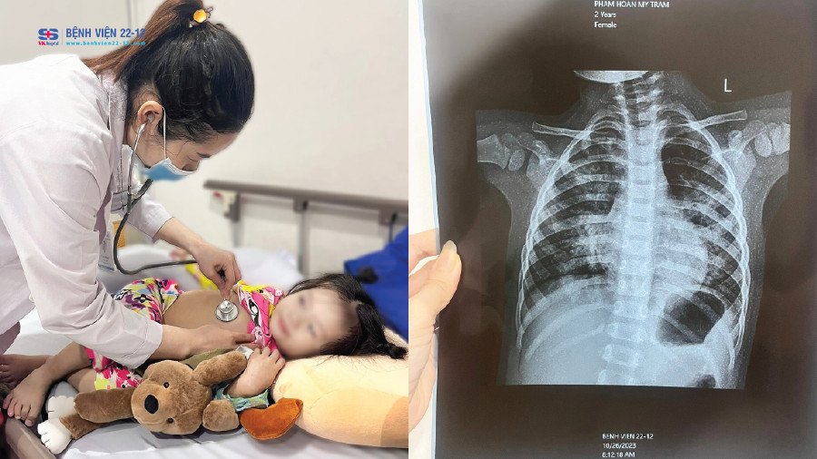 Bệnh viện 22-12 | Viêm phổi nặng Bệnh viện 22-12 | Viêm phổi nặng