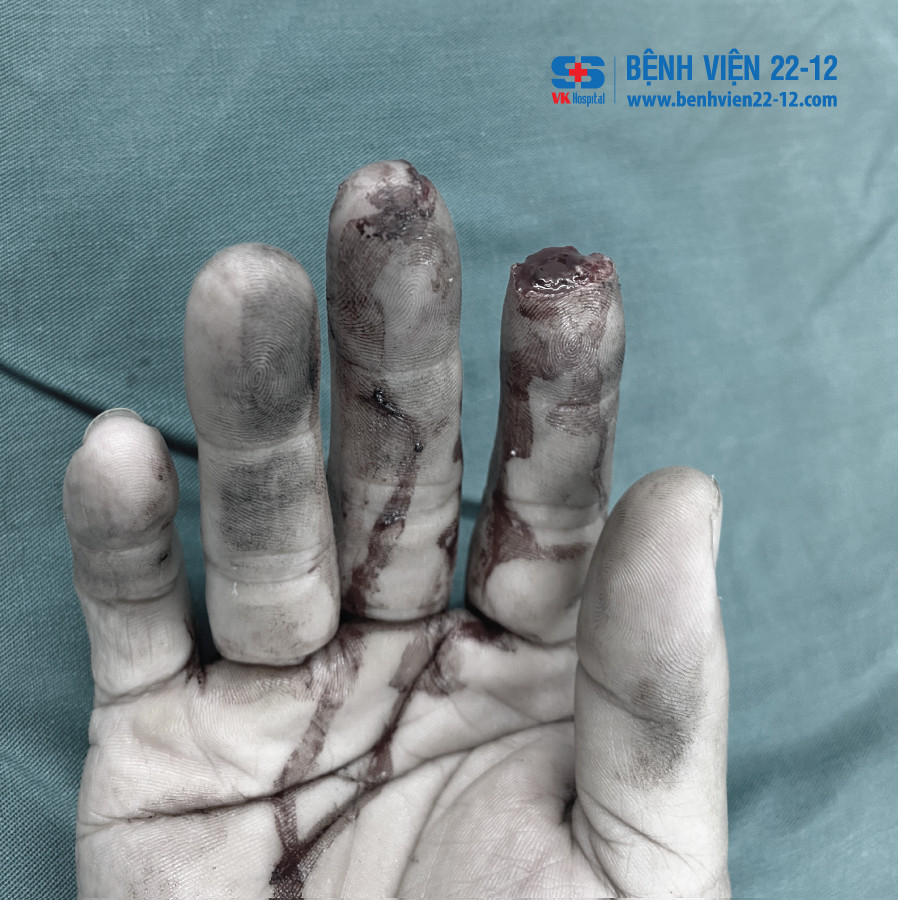 Benh vien 22-12 | Phau thuat lam vat V-Y che phu mom cut dot xa cho benh nhan bi cat ngon tay