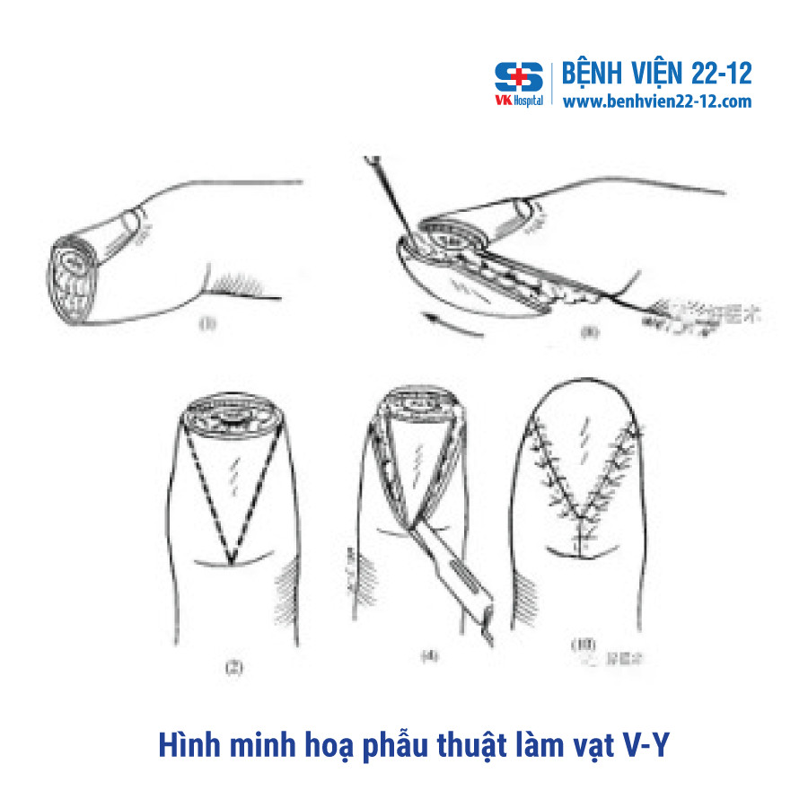 Benh vien 22-12 | Phau thuat lam vat V-Y che phu mom cut dot xa cho benh nhan bi cat ngon tay