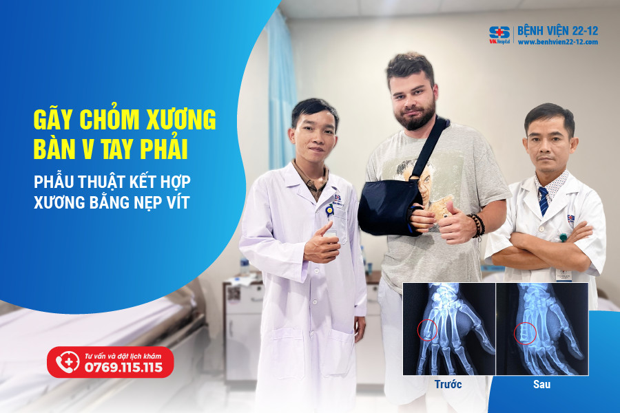Benh vien 22-12 | Gay chom xuong ban V tay phai Benh vien 22-12 | Gay chom xuong ban V tay phai