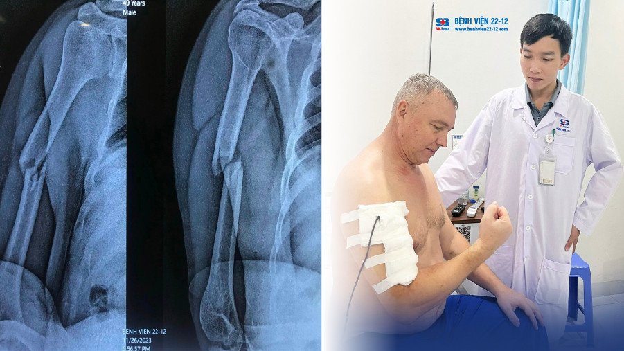 Bệnh viện 22-12 | Phẫu thuật gãy di lệch 1/3 xương cánh tay