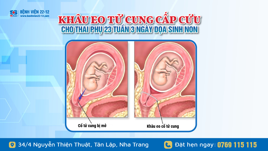 Bệnh viện 22-12 | Khâu eo tử cung cho thai phụ dọa sinh non Bệnh viện 22-12 | Khâu eo tử cung cho thai phụ dọa sinh non