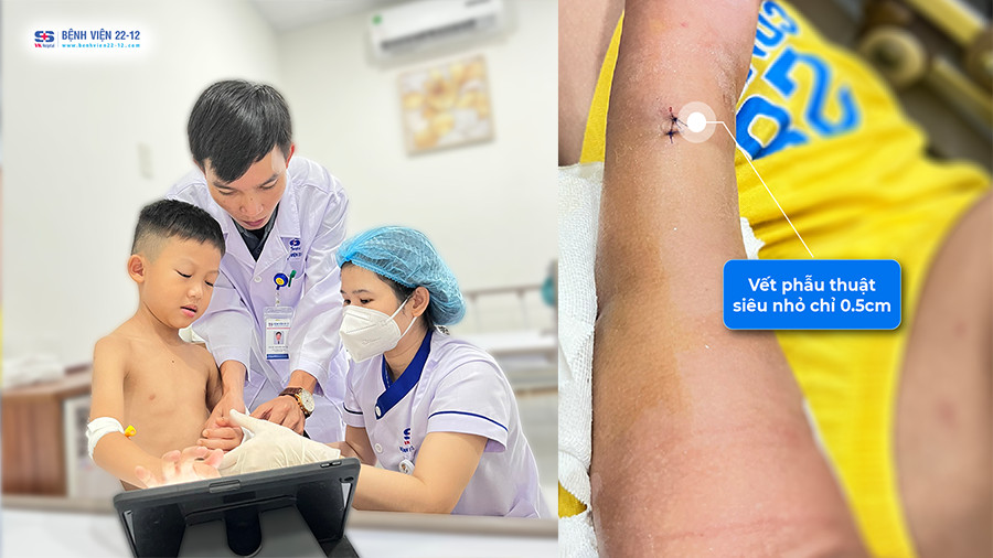 Bệnh viện 22-12 | Phẫu thuật kết hợp xương bé 6 tuổi