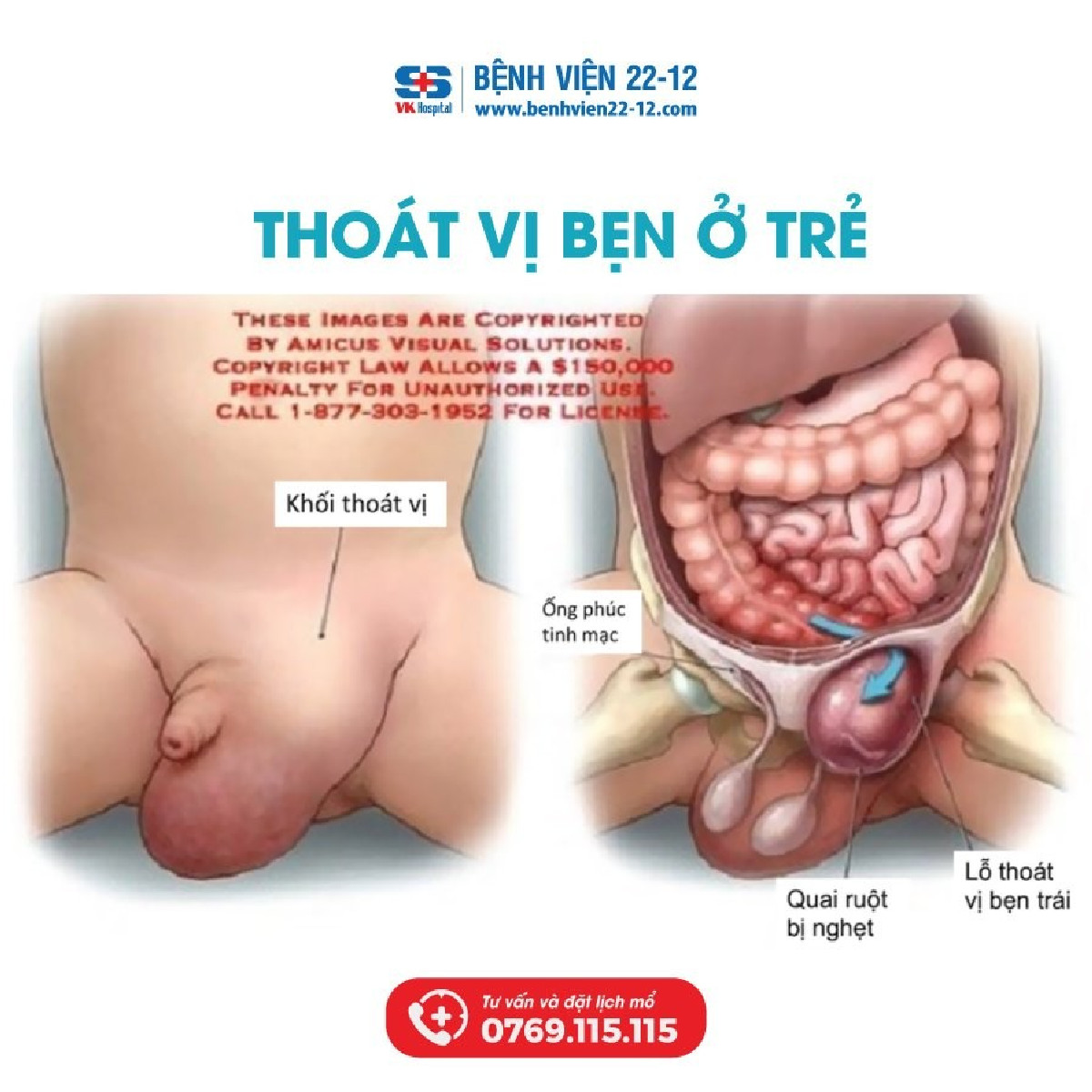 Benh vien 22-12 | Thoat vi ben o em be 39 thang Benh vien 22-12 | Thoat vi ben o em be 39 thang