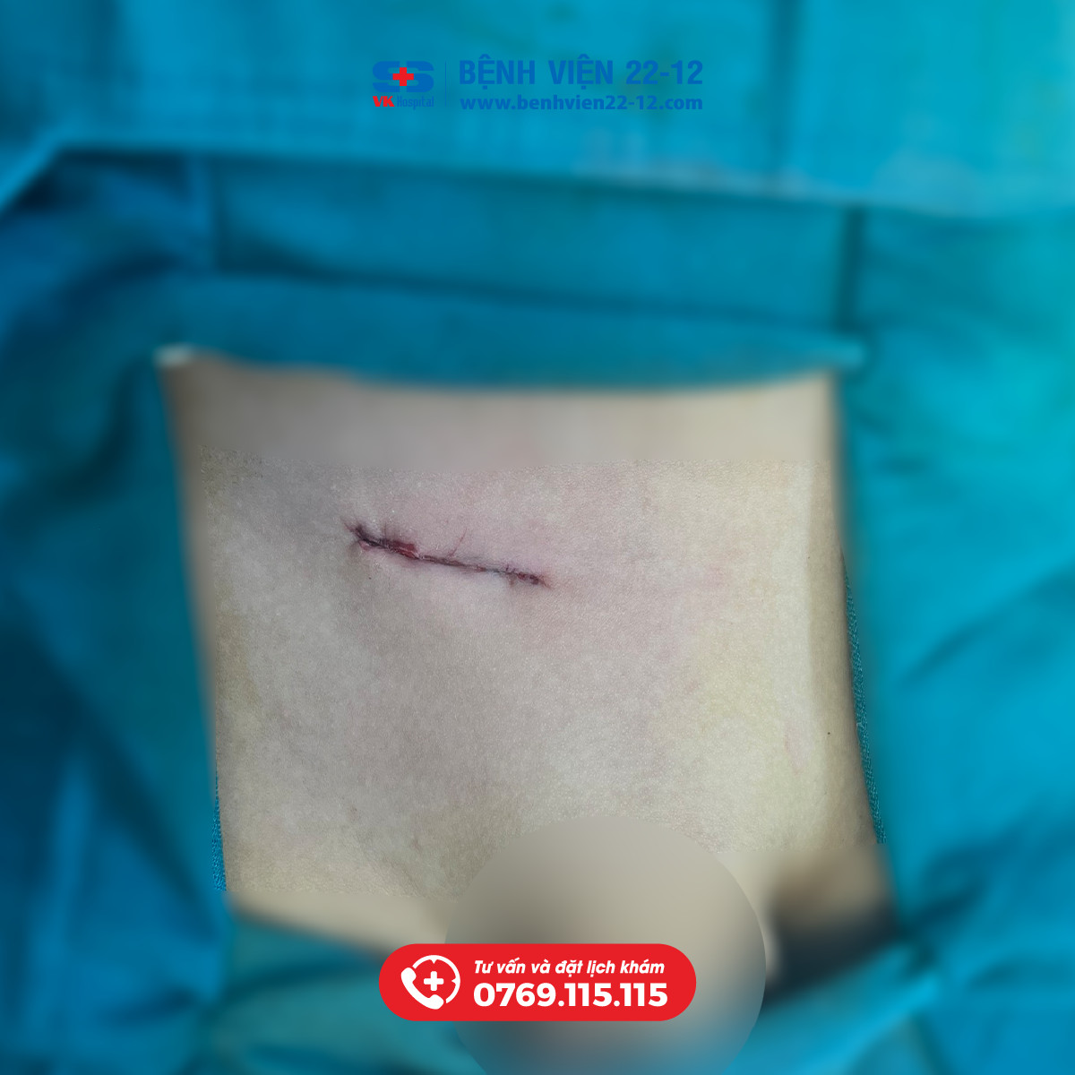 Benh vien 22-12 | Thoat vi ben o em be 39 thang Benh vien 22-12 | Thoat vi ben o em be 39 thang