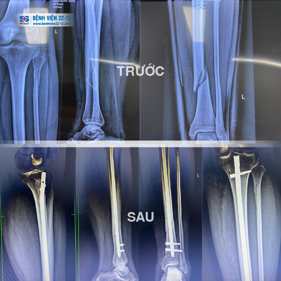 Benh vien 22-12 | Phẫu thuật kết hợp xương chày dưới máy C-ARM bằng đinh SIGN cho bệnh nhân người nga. Benh vien 22-12 | Phẫu thuật kết hợp xương chày dưới máy C-ARM bằng đinh SIGN cho bệnh nhân người nga.