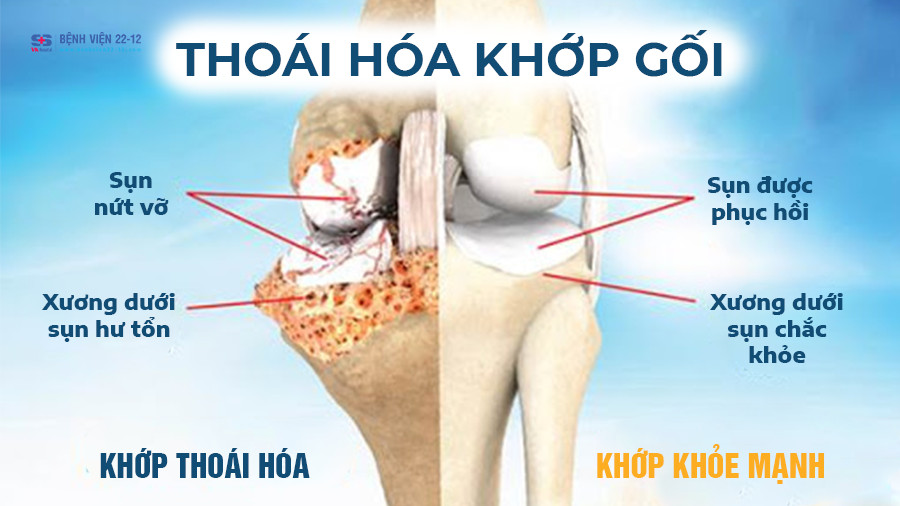 Bệnh viện 22-12 \ Thoái hóa khớp gối Bệnh viện 22-12 \ Thoái hóa khớp gối