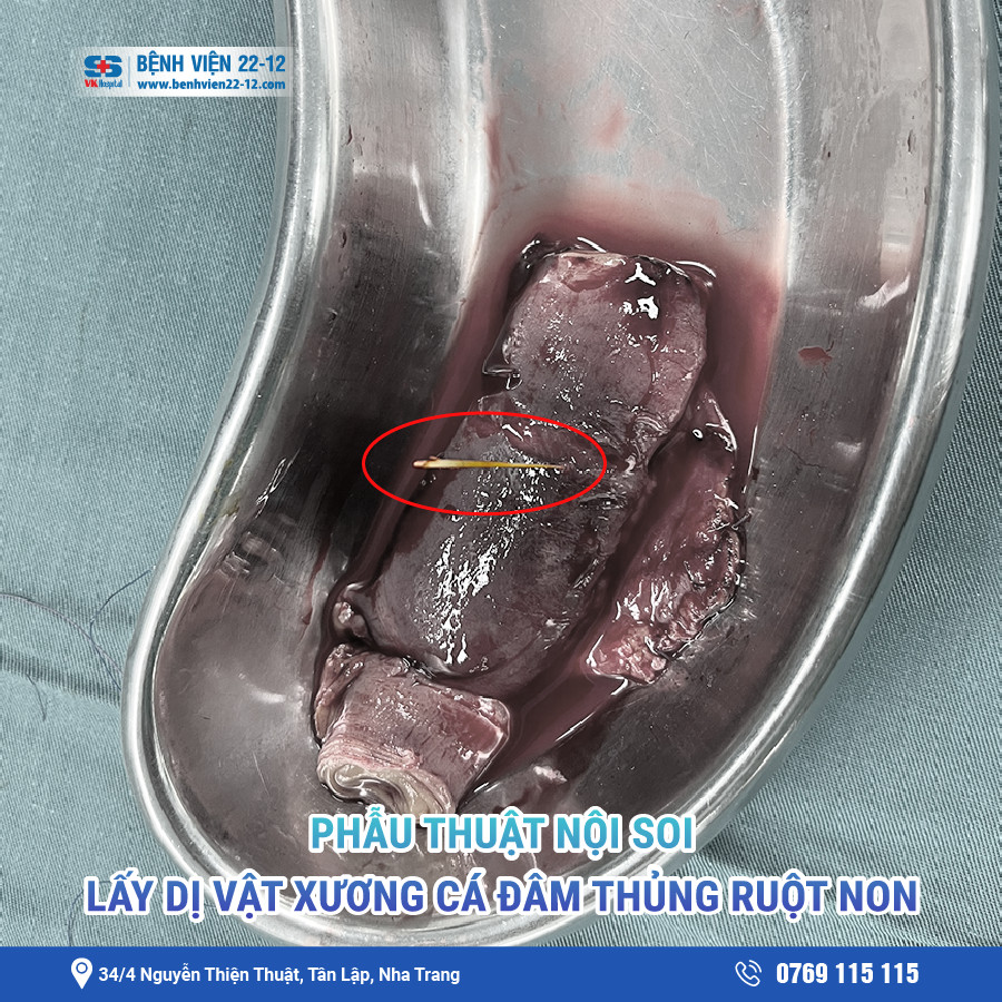 Bệnh viện 22-12 | Dị vật xương cá trong ruột non Bệnh viện 22-12 | Dị vật xương cá trong ruột non