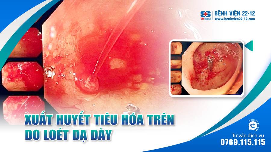 Bệnh viện 22-12 | Xuất huyết tiêu hóa trên do loét dạ dày Bệnh viện 22-12 | Xuất huyết tiêu hóa trên do loét dạ dày