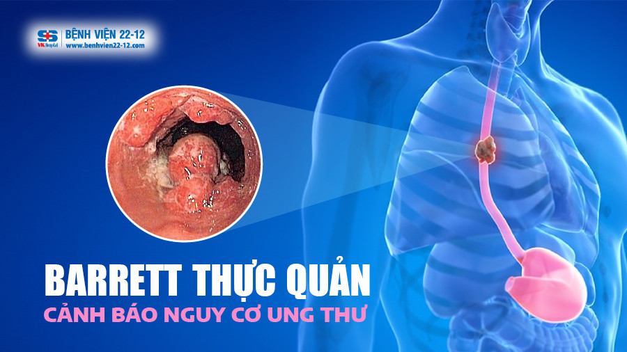 Bệnh viện 22-12 | Nguy cơ ung thư từ bệnh barrett thực quản Nguy cơ ung thư từ bệnh barrett thực quản