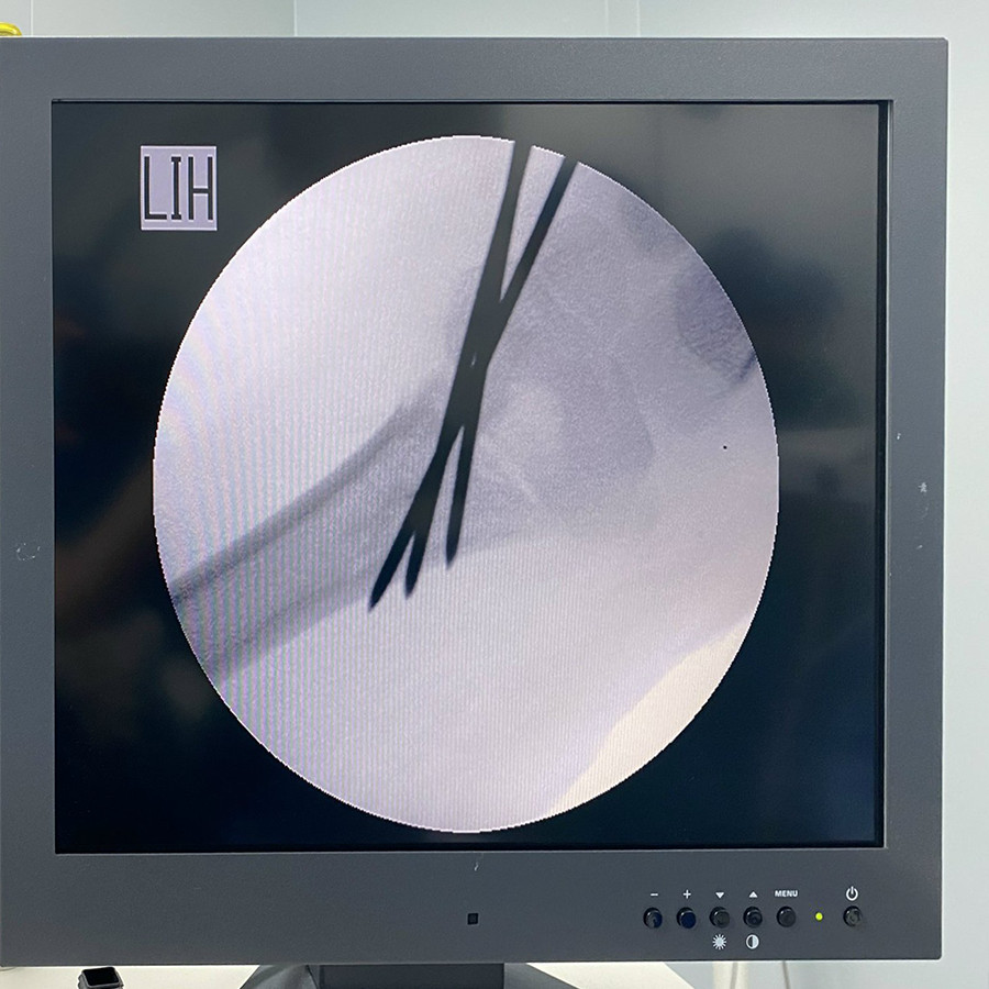 Bệnh viện 22-12 | Phẫu thuật kết hợp xương gãy trên lồi cầu xương cánh tay phải cho bé gái 6 tuổi Bệnh viện 22-12 | Phẫu thuật kết hợp xương gãy trên lồi cầu xương cánh tay phải cho bé gái 6 tuổi