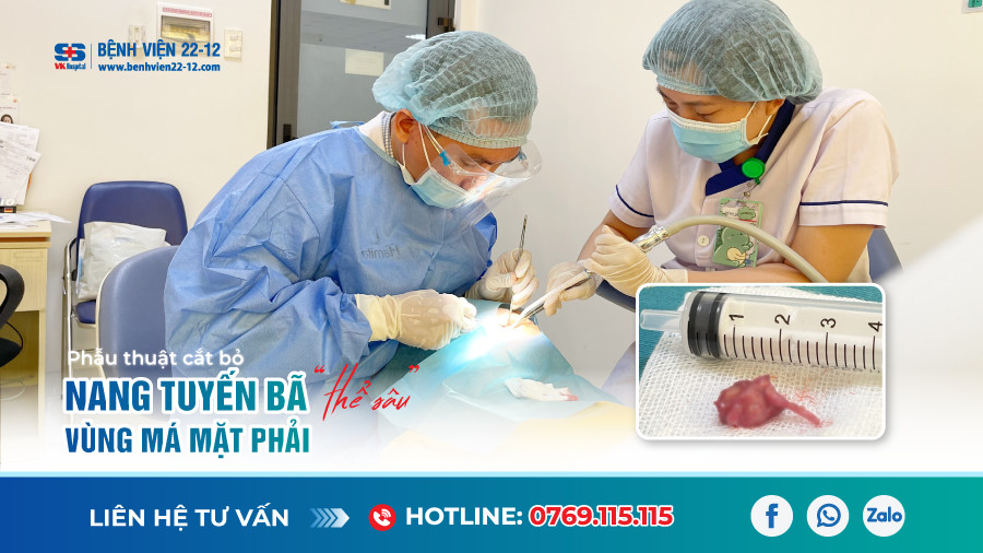 Bệnh viện 22-12 | Nang tuyến bã vùng má Bệnh viện 22-12 | Nang tuyến bã vùng má