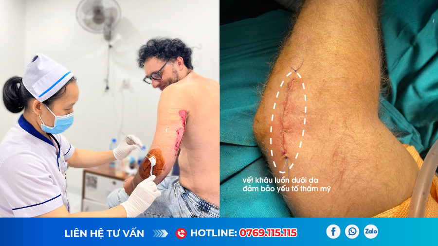 Bệnh viện 22-12 | Gãy kín đài quay tay trái do TNGT Bệnh viện 22-12 | Gãy kín đài quay tay trái do TNGT