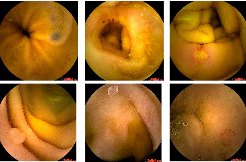 Hình ảnh các trường hợp có bất thường thu được qua nội soi viên nang. Hình ảnh các trường hợp có bất thường thu được qua nội soi viên nang.