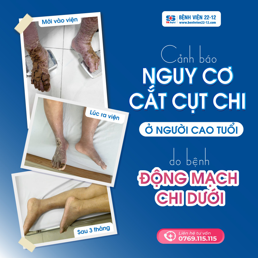 Bệnh viện 22-12 | Cảnh báo nguy cơ cắt cụt chi ở người cao tuổi do bệnh động mạch chi dưới Cảnh báo nguy cơ cắt cụt chi ở người cao tuổi do bệnh động mạch chi dưới