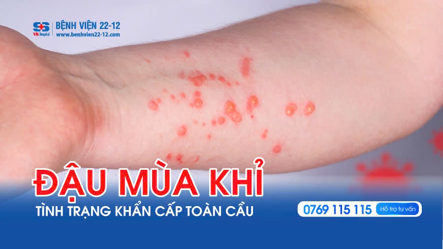 Đậu Mùa Khỉ Tình Trạng Khẩn Cấp Toàn Cầu Đậu Mùa Khỉ Tình Trạng Khẩn Cấp Toàn Cầu
